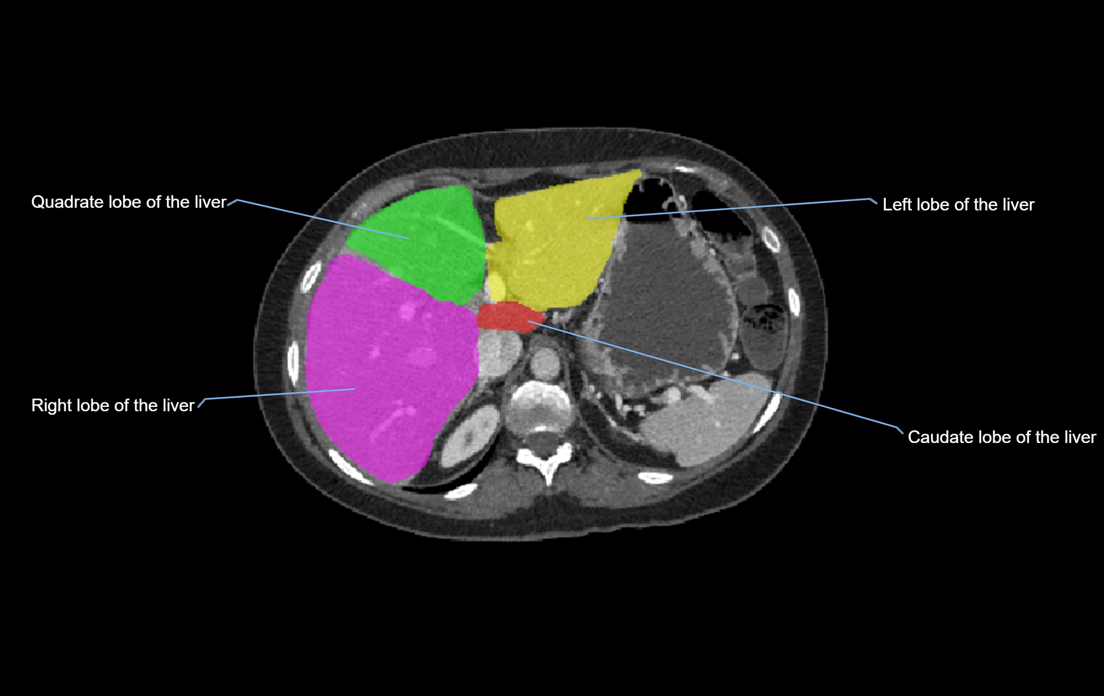 CT lliver lobes axial cross sectional anatomy labelled image -00051.webp